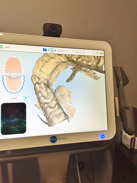 Smile Direct Club review featured by top US life and style blog, Hello! Happiness